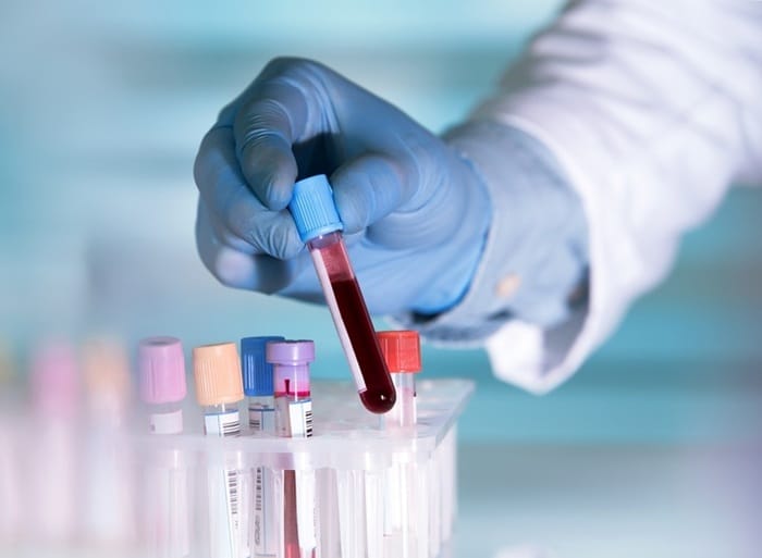 Xét nghiệm máu giúp sàng lọc nguy cơ ung thư đại tràng