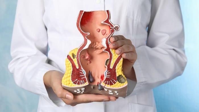 Thời gian lành sau mổ nứt kẽ hậu môn phụ thuộc nhiều yếu tố