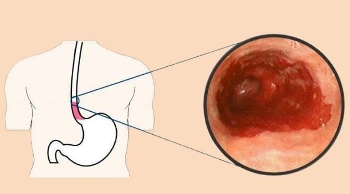Dạ dày có thể bị viêm loét nghiêm trọng
