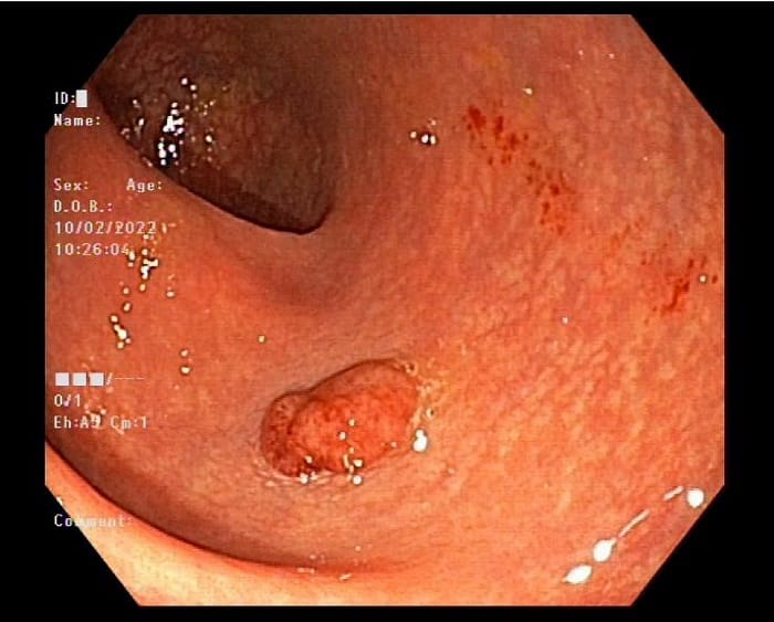 Nội soi giúp phát hiện các tế bào ung thư hay các bệnh lý