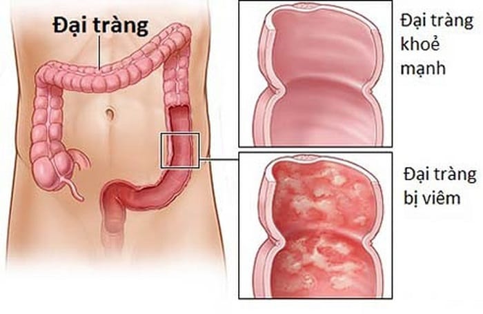 Nội soi đại tràng sẽ phát hiện được các bệnh lý nguy hiểm