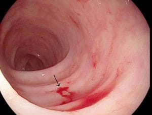 Nội soi đại tràng có ảnh hưởng gì không? một số dấu hiệu cần lưu ý