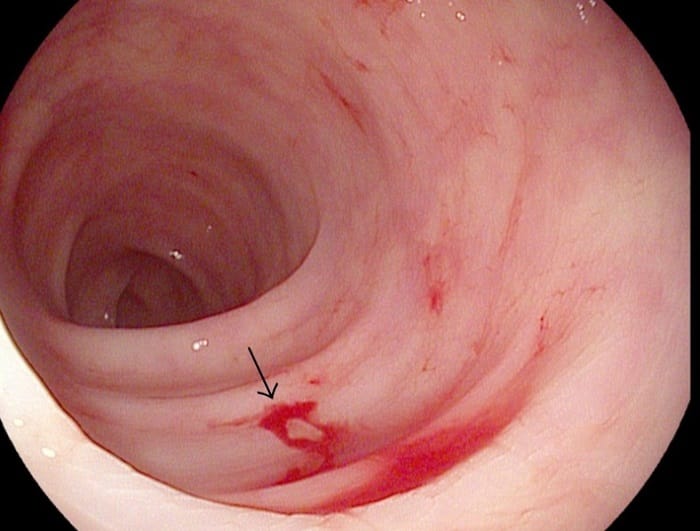Sau nội soi đại tràng có thể xuất hiện một số tác dụng phụ