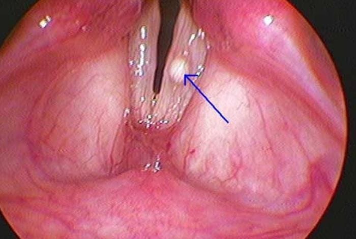 Có polyp thanh quản