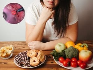 Polyp đại tràng kiêng ăn gì? bác sĩ giải đáp nhanh