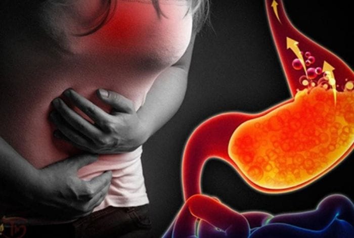 viêm loét dạ dày – tá tràng nên test HP