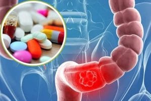 7 Loại thuốc chữa viêm đại tràng tốt nhất hiện nay được bác sĩ khuyên dùng