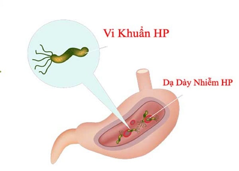 Trào ngược dạ dày sẽ lây nếu do vi khuẩn HP