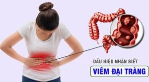 9 Dấu hiệu nhận biết viêm đại tràng thường gặp
