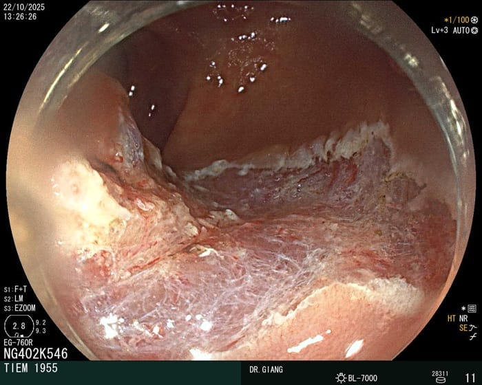 Đại tràng có bờ trắng