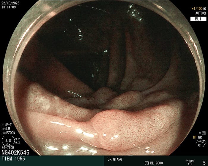 Viêm đại tràng co thắt