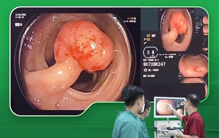 Niêm mạc dạ dày co thắt, có xuất hiện polyp khi quan sát nội soi