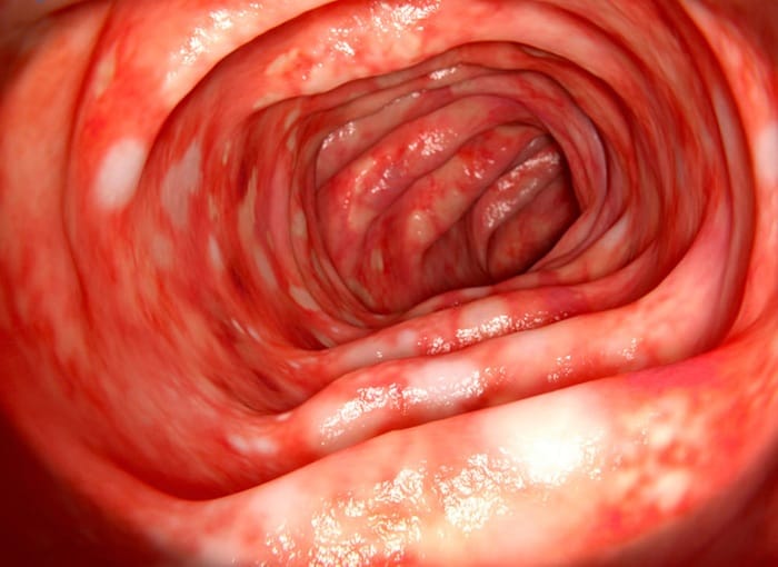 Viêm loét đỏ rõ ràng trong đại tràng khi nội soi