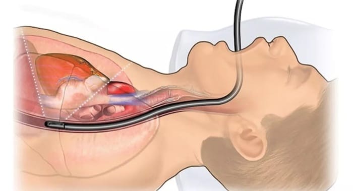 Nội soi qua đường miệng