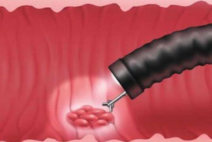 Nội soi dạ dày sinh thiết là gì? Dấu hiệu cần nội soi sinh thiết