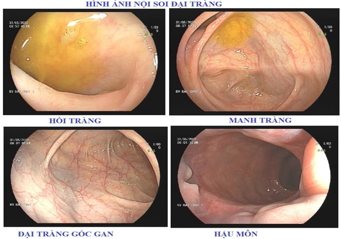 Cho hình ảnh nội soi rõ nét, chính xác niêm mạc đại trực tràng