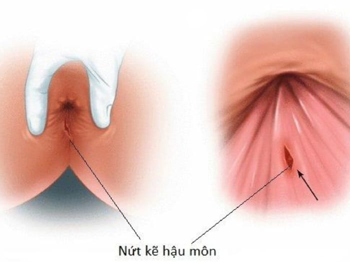 Nứt kẽ hậu môn do đại tiện quá mạnh gây ra