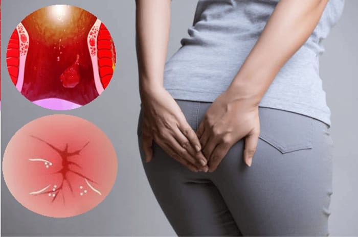 Sưng đau, chảy máu vùng hậu môn