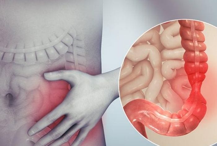 Chữa viêm đại tràng cần dựa theo tình trạng mỗi người