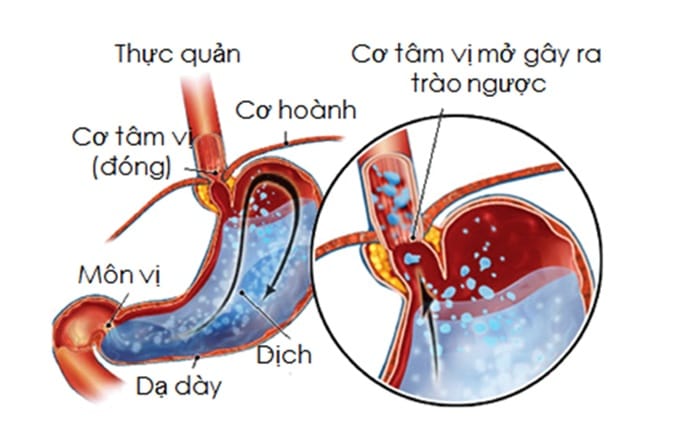 Chủ yếu do dịch axit bị trào ngược lên thực quản gây nghẹt mũi