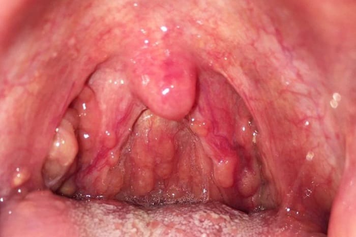 Biến chứng nguy hiểm nếu không điều trị sớm trào ngược dạ dày