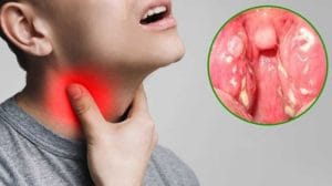 4 Nguyên nhân gây trào ngược dạ dày gây viêm họng