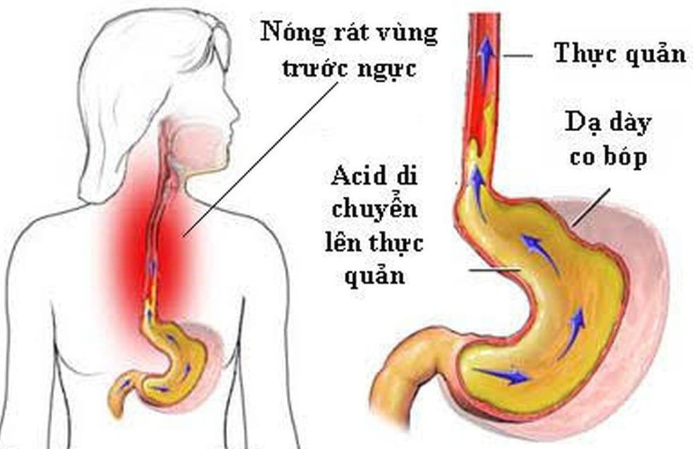 Cần kiêng đồ chua, cay nóng để tránh axit trào ngược lên thực quản - dạ dày