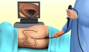 Trước khi nội soi đại tràng nên ăn gì? Danh sách thực phẩm cần biết