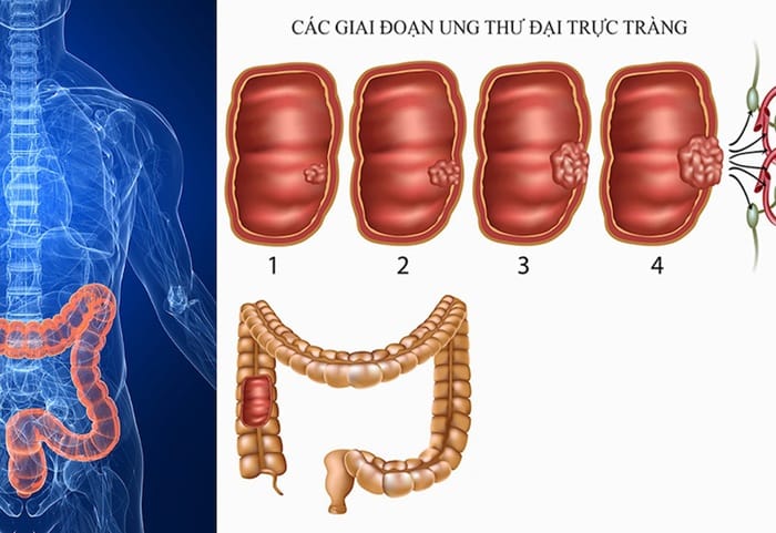Tùy vào giai đoạn bệnh ảnh hưởng tới tiên lượng sống