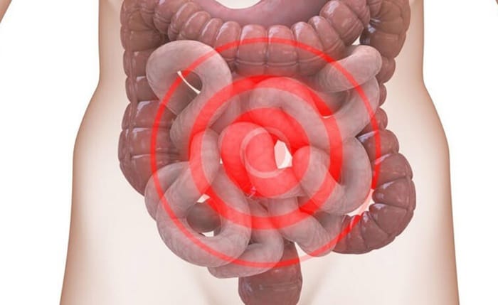 Viêm đại tràng co thắt gây đau quặn bụng, rối loạn tiêu hóa 