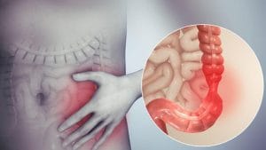 Viêm đại tràng co thắt? nguyên nhân và cách điều trị dứt điểm