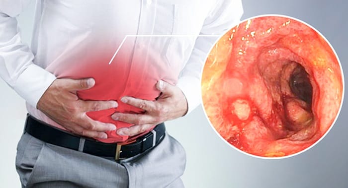 Viêm đại tràng không điều trị sớm có thể gây biến chứng nguy hiểm cho sức khỏe