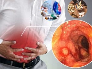 Điều trị viêm đại tràng mãn tính? Gợi ý 5 phương pháp điều trị hiệu quả mãn tính