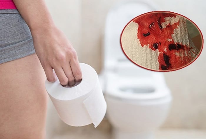 Đại tiện ra máu cần phải đi khám ngay để kiểm tra