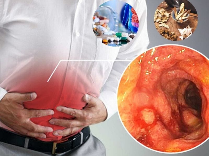 Điều trị viêm đại tràng mãn tính