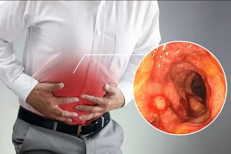 Viêm đại tràng không điều trị sớm có thể gây biến chứng nguy hiểm