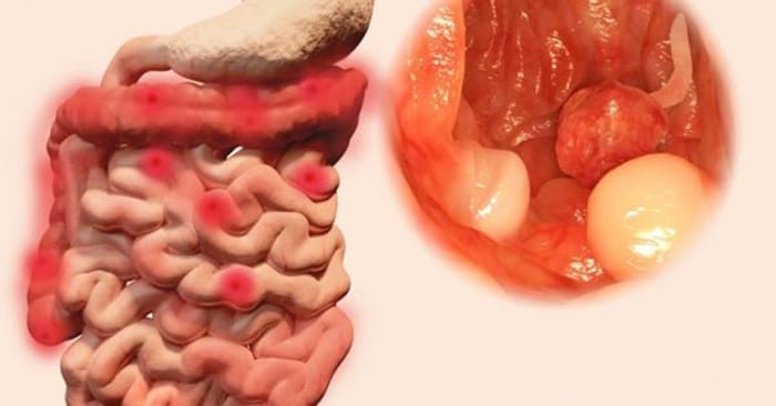 Xuất huyết đại tràng biến chứng nguy hiểm do không chữa viêm đại tràng