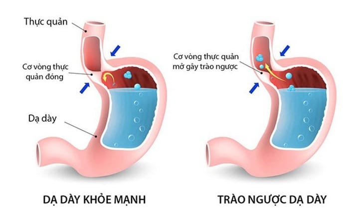 Do cơ vòng thực quản dưới yếu dẫn tới viêm trào ngược dạ dày