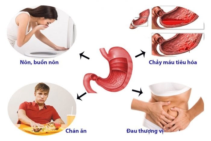 Triệu chứng điển hình khi bị viêm trào ngược dạ dày