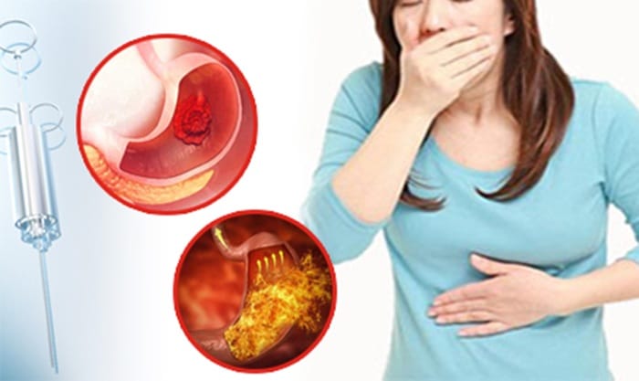 Xuất huyết dạ dày biến chứng nguy hiểm khi không điều trị trào ngược