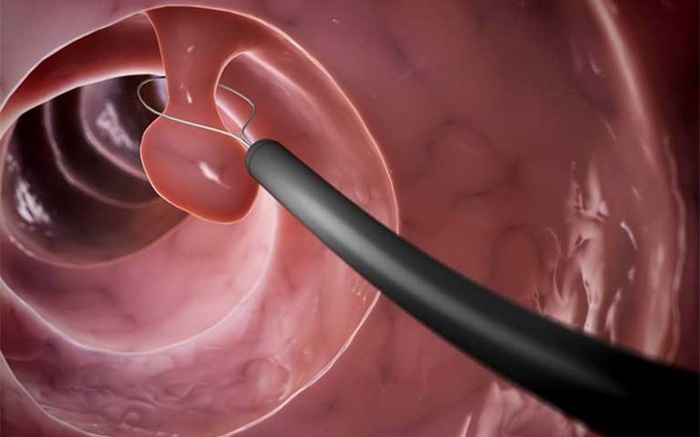 Cắt polyp cổ tử cung bao lâu thì lành? Khi nào sinh hoạt lại bình thường