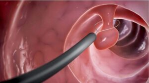 Cắt polyp tử cung có phải nằm viện không, khi nào cần nằm viện