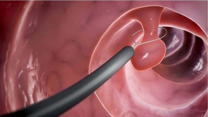 Cắt polyp tử cung có phải nằm viện không, khi nào cần nằm viện