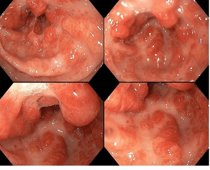 Hình ảnh nội soi dạ dày nghi ngờ ung thư có viêm loét