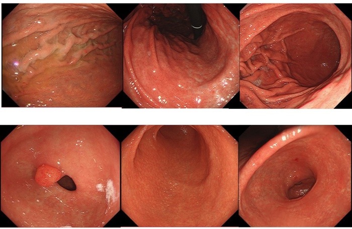 Ổ loét gồ ghề ở niêm mạc khi nội soi dạ dày