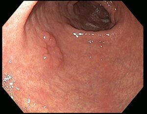 Hình ảnh nội soi dạ dày bị ung thư, các đặc điểm nhận biết