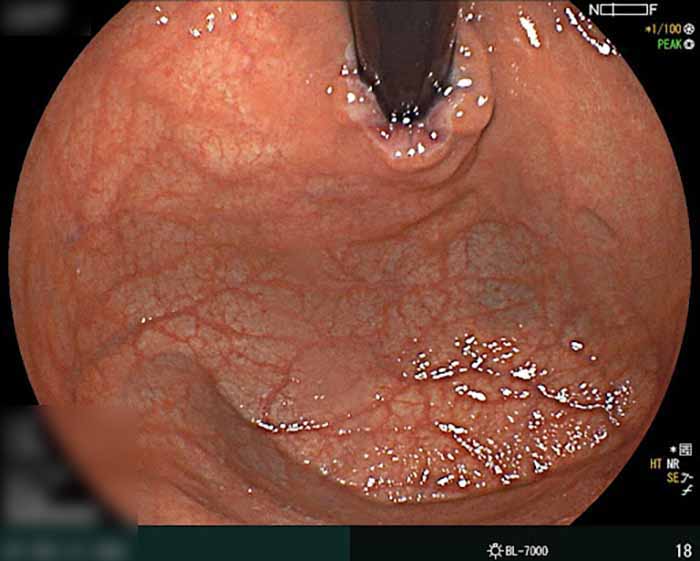 Nội soi dạ dày dương tính có thể gây viêm loét