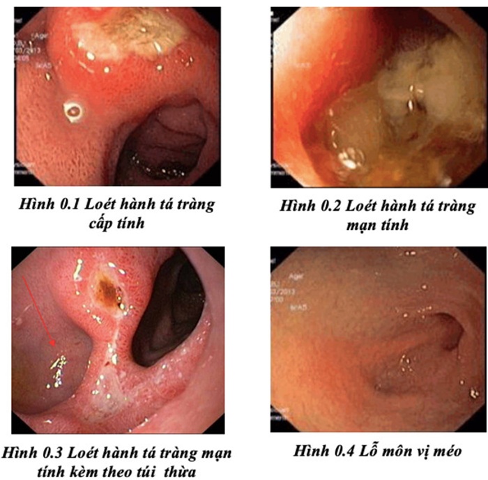 Phân độ Forrest thang độ đo mức độ chảy máu loét dạ dày