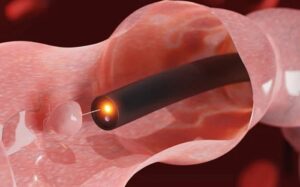 Polyp đại tràng cắt rồi có mọc lại không, các yếu tố làm tăng nguy cơ