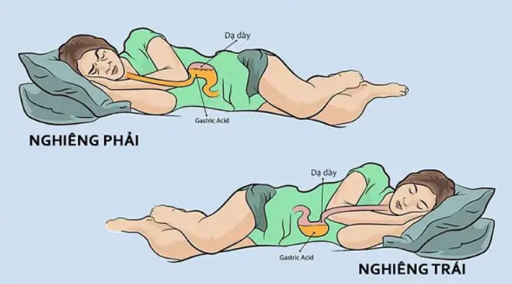 Ưu tiên nằm nghiêng bên trái và kê gối cao đầu